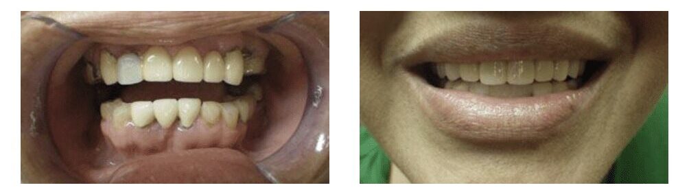 SMILE GALLERY Dr. Justin Nylander. Allen Dentistry. General, Cosmetic, Restorative, Preventative Dentistry. Dentist in Allen, TX 75013